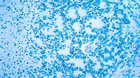 Possible Cellular Origin of Neuroblastoma Discovered