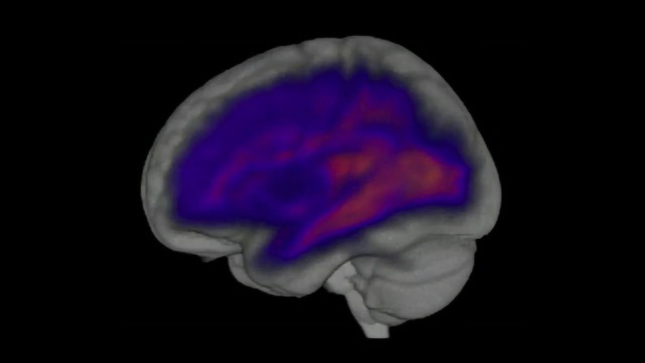 Damage to White Matter Linked to Worse Post-Brain Injury Outcomes