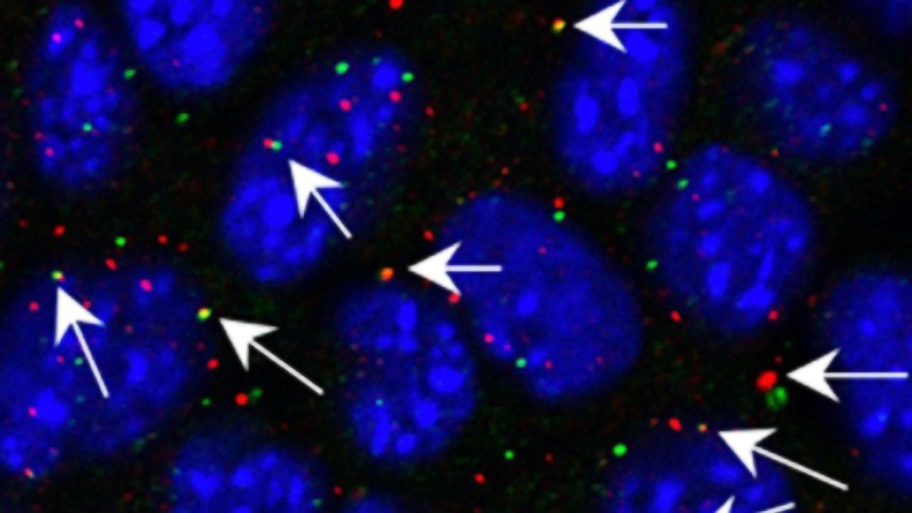 Esophageal Cancers Resurrect Ancient Retroviruses Embedded in Our Genome