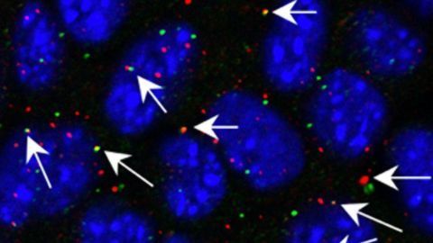 Esophageal Cancers Resurrect Ancient Retroviruses Embedded in Our Genome