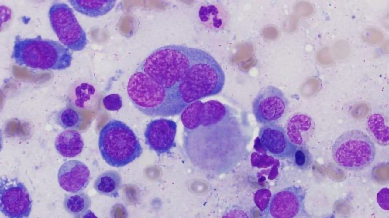 Myelodysplastic Syndrome Bone Marrow