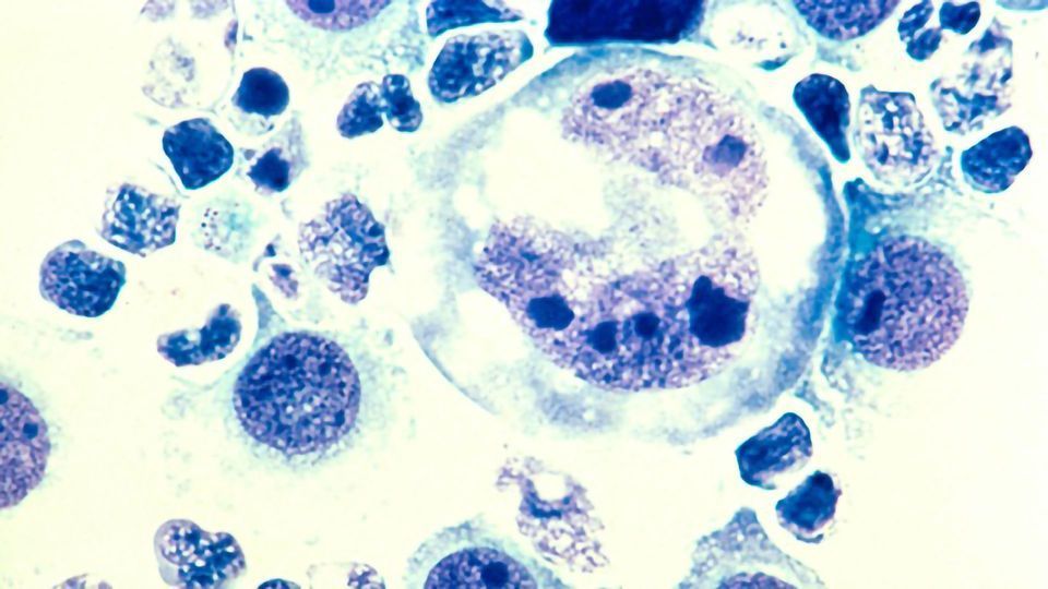 Preclinical Study Finds NK Cells Show Activity Against Lymphoma Cells content piece image