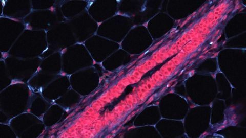 Cataloging Cells To Pinpoint Origins of Breast Cancer