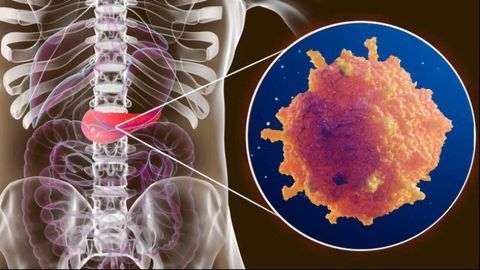Shedding Light on Mechanisms of Metastasis in Pancreatic Cancer