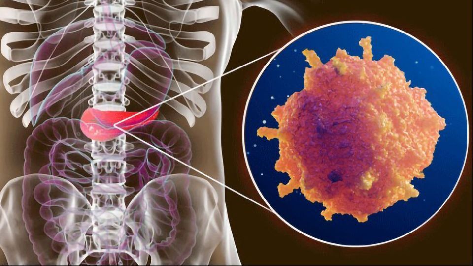 Shedding Light on Mechanisms of Metastasis in Pancreatic Cancer content piece image