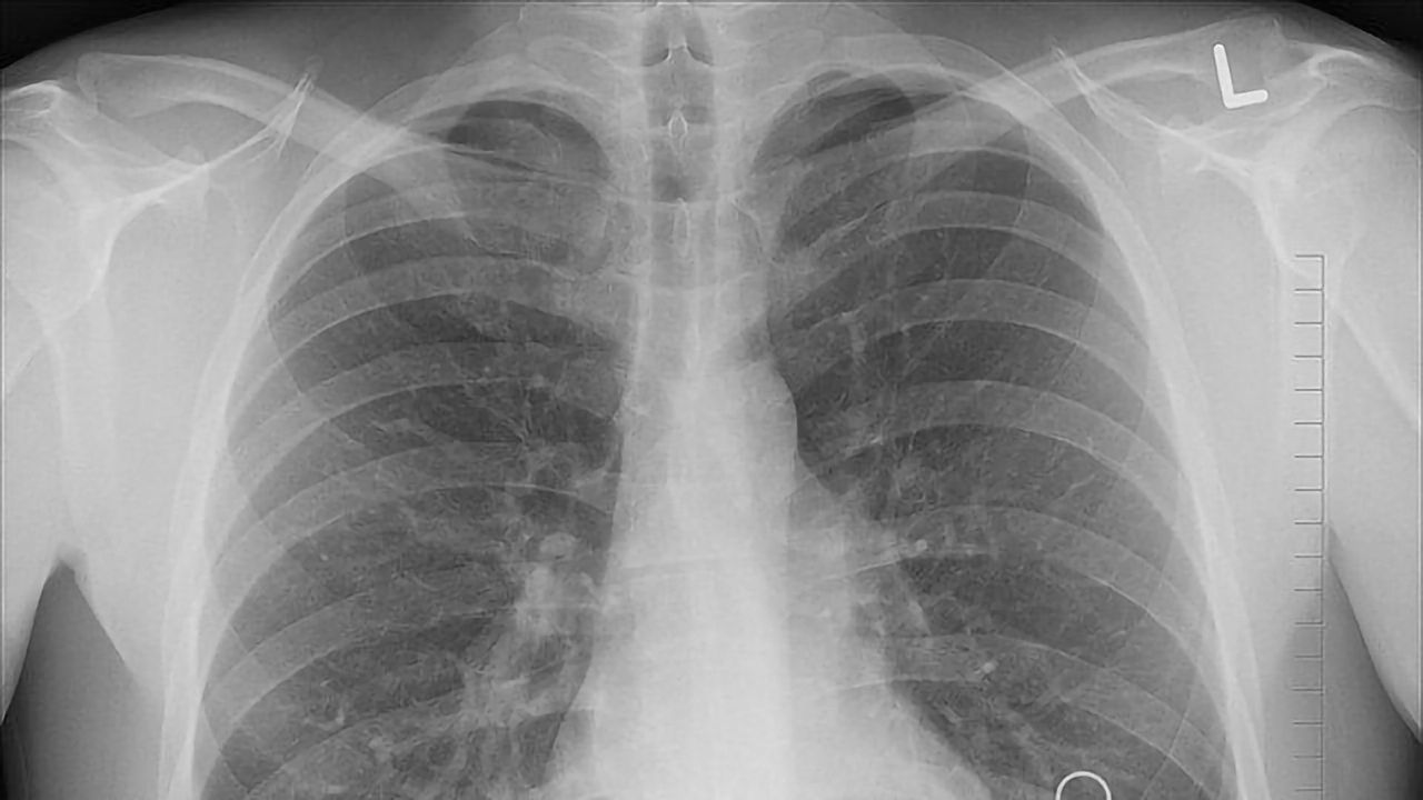 Interactions Between Microbial Networks Impact Lung Infections