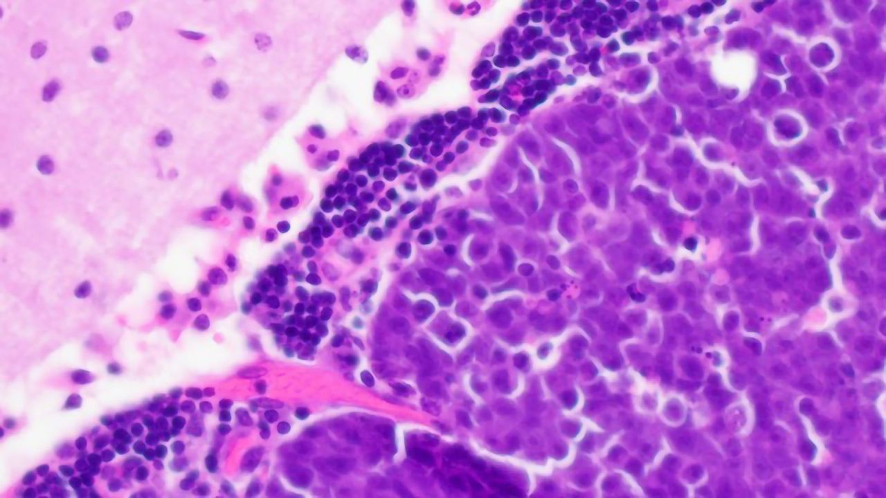 Targeting Abnormal Cell Metabolism To Treat Pediatric Brain Cancer