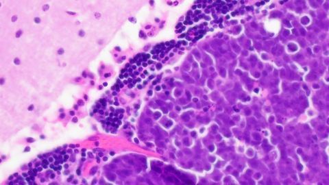 Targeting Abnormal Cell Metabolism To Treat Pediatric Brain Cancer