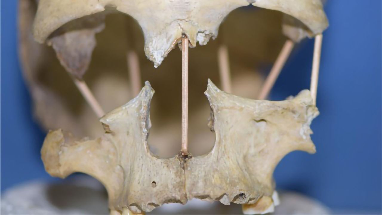 Successful Genome Sequencing of 35,000-Year-Old Skull