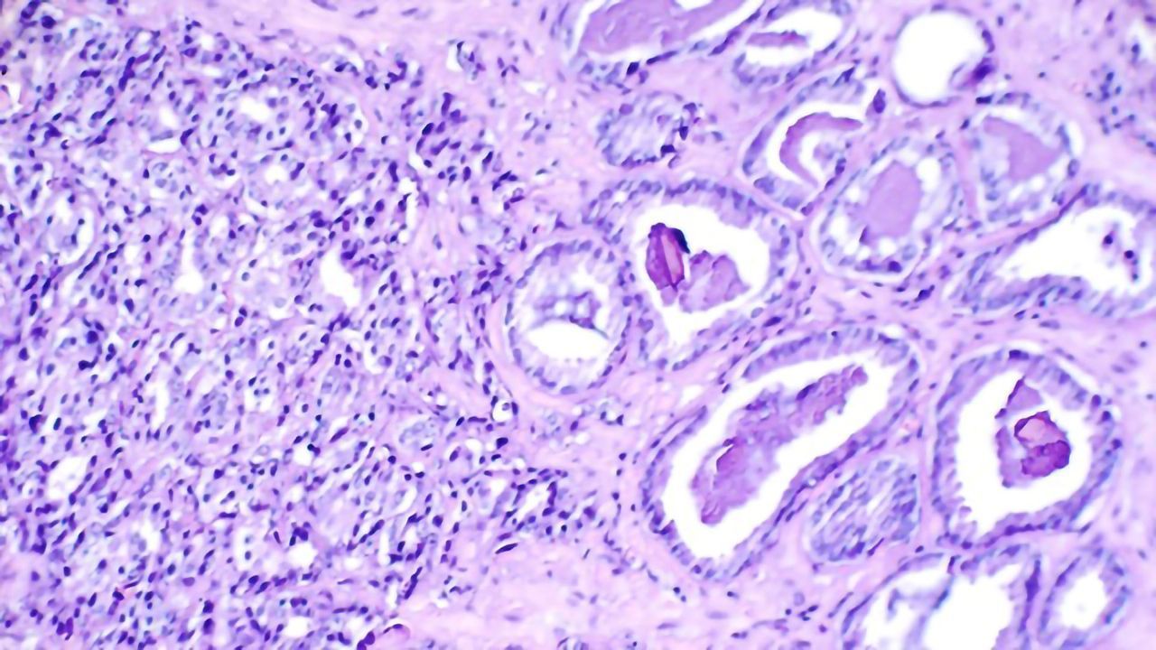 Drug Target for Treating Aggressive Prostate Cancer