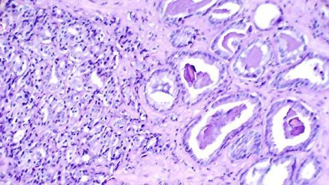 Drug Target for Treating Aggressive Prostate Cancer