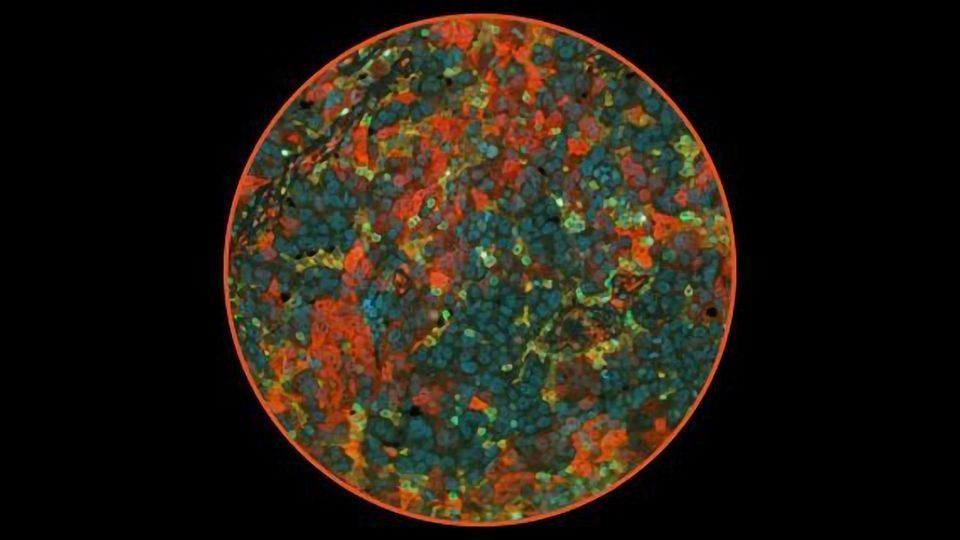  Identifying Platinum Chemotherapy Resistance in Patients With Ovarian Cancer content piece image