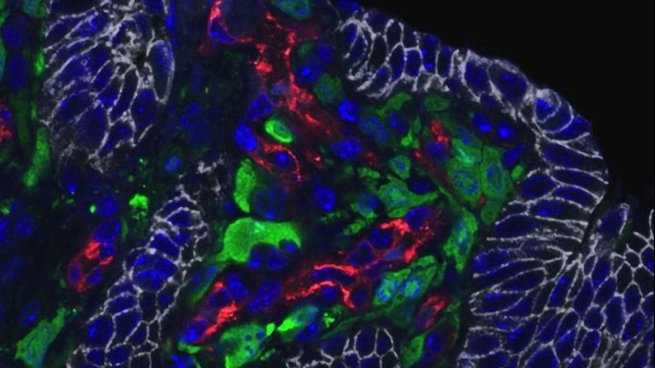IL-11+ Cells Are Located Adjacent to Tumor Cells