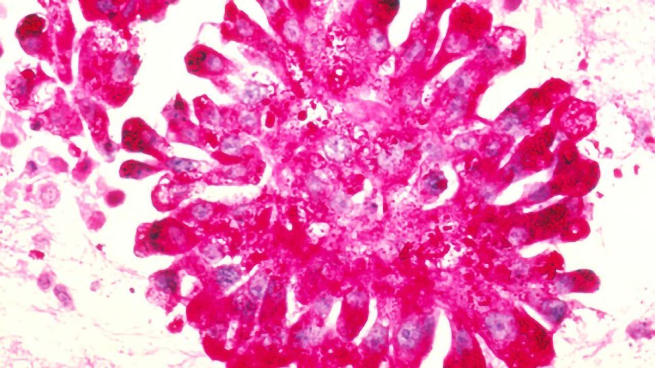 Gene Linked to Bone Cancer in Children