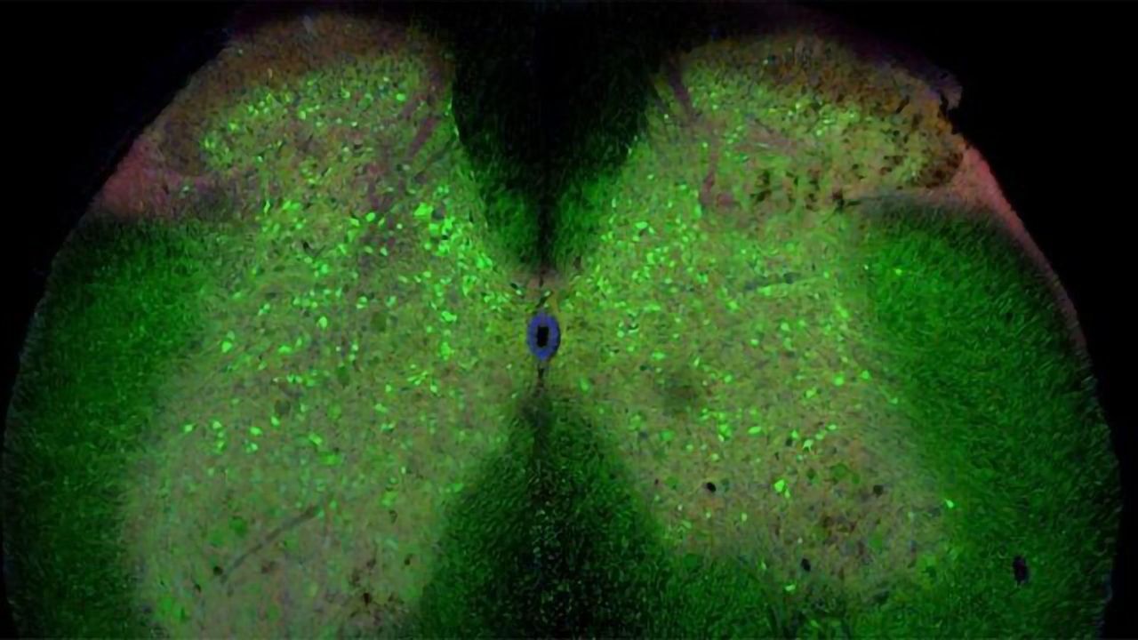 Loss of Spinal Cord Connections May Trigger ALS