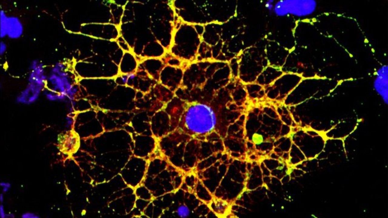HIV Virus Shrinks the Brain's White Matter