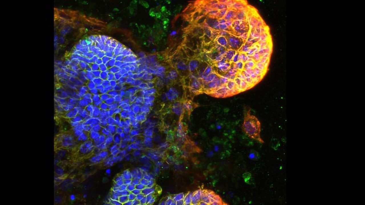 Bowel Cancer Recurrence Could Be Predicted by Blood Biomarker