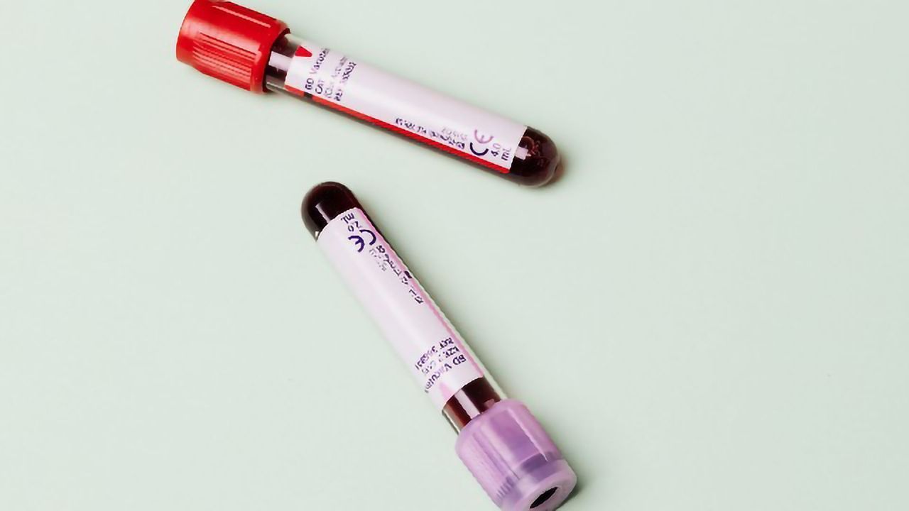 Simple Blood Test Can Accurately Identify Underlying Neurodegeneration