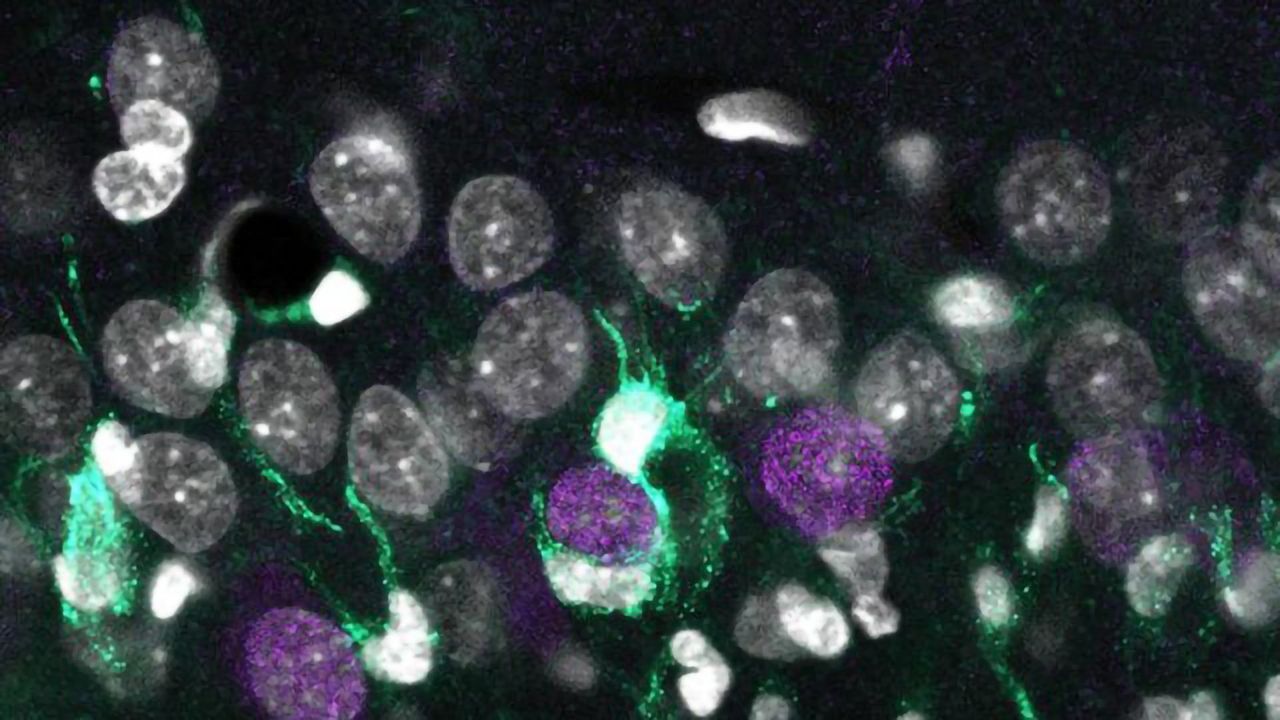 Genetic “Map” of Neuronal Death That Is Present in Drug-Resistant Epilepsy
