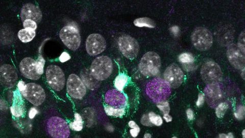 Genetic “Map” of Neuronal Death That Is Present in Drug-Resistant Epilepsy