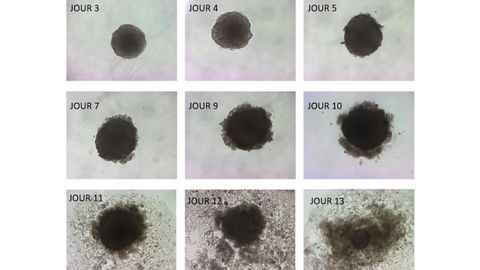 Omega-3 Fatty Acid Kills Tumor Cells in Culture
