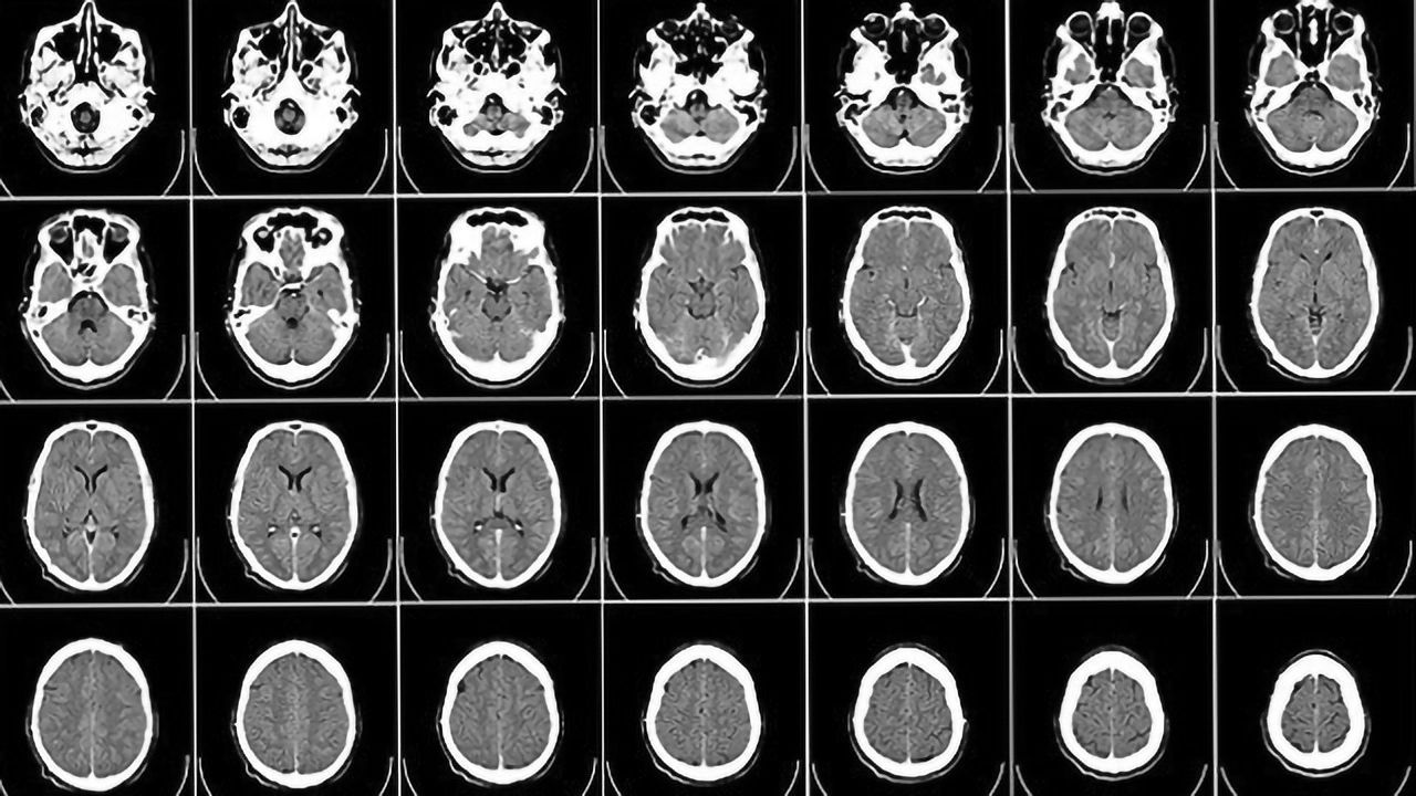 Brain Imaging Breakthrough May Offer MRI Alternative