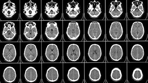 Brain Imaging Breakthrough May Offer MRI Alternative