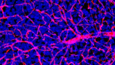 A New Path Towards Brain Tumor Therapy