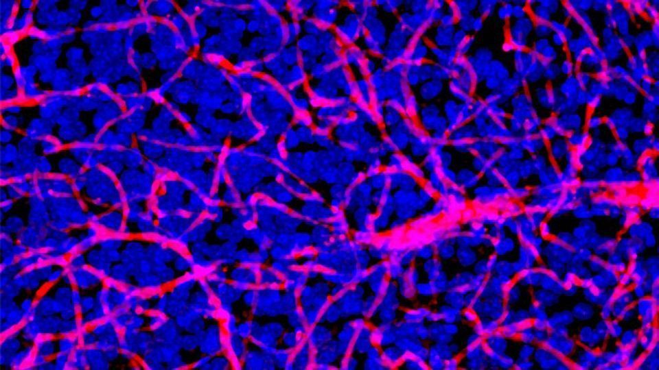 A New Path Towards Brain Tumor Therapy content piece image