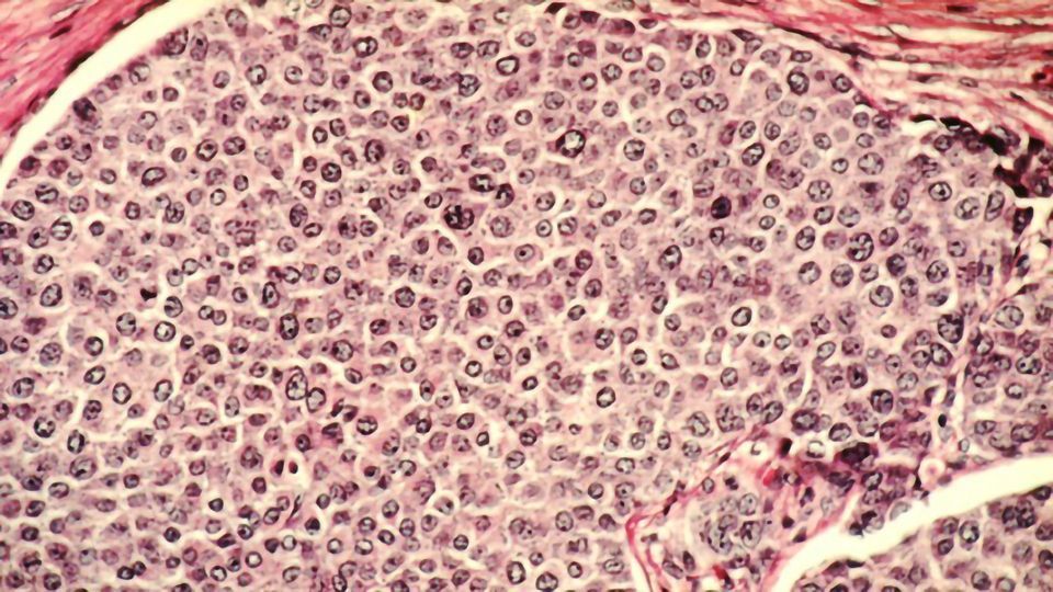 “Enabler Cells” Inside Tumors Can Trigger Metastasis content piece image