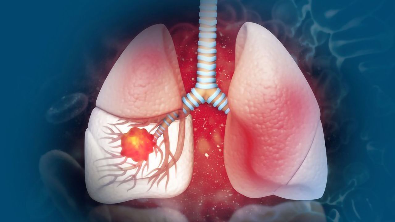 A Novel Nasal Swab for Lung Cancer Detection