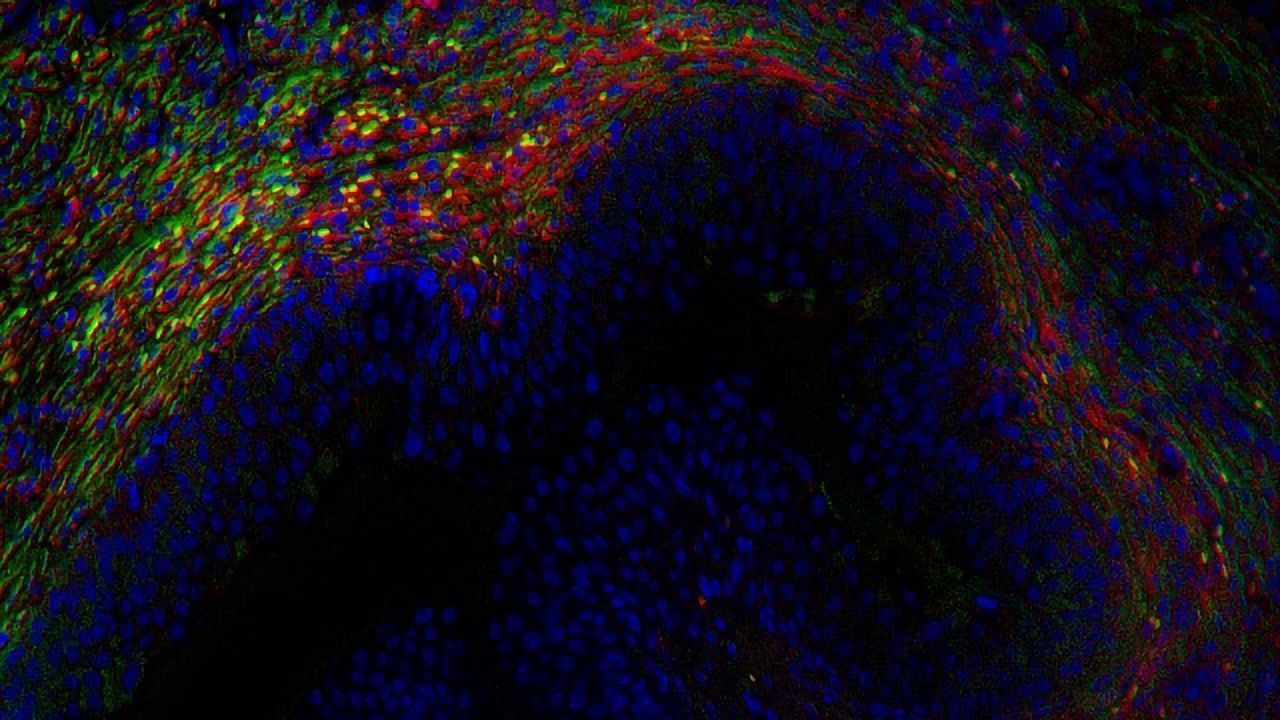 Blood Test Could Guide Precision Treatment in Bladder Cancer