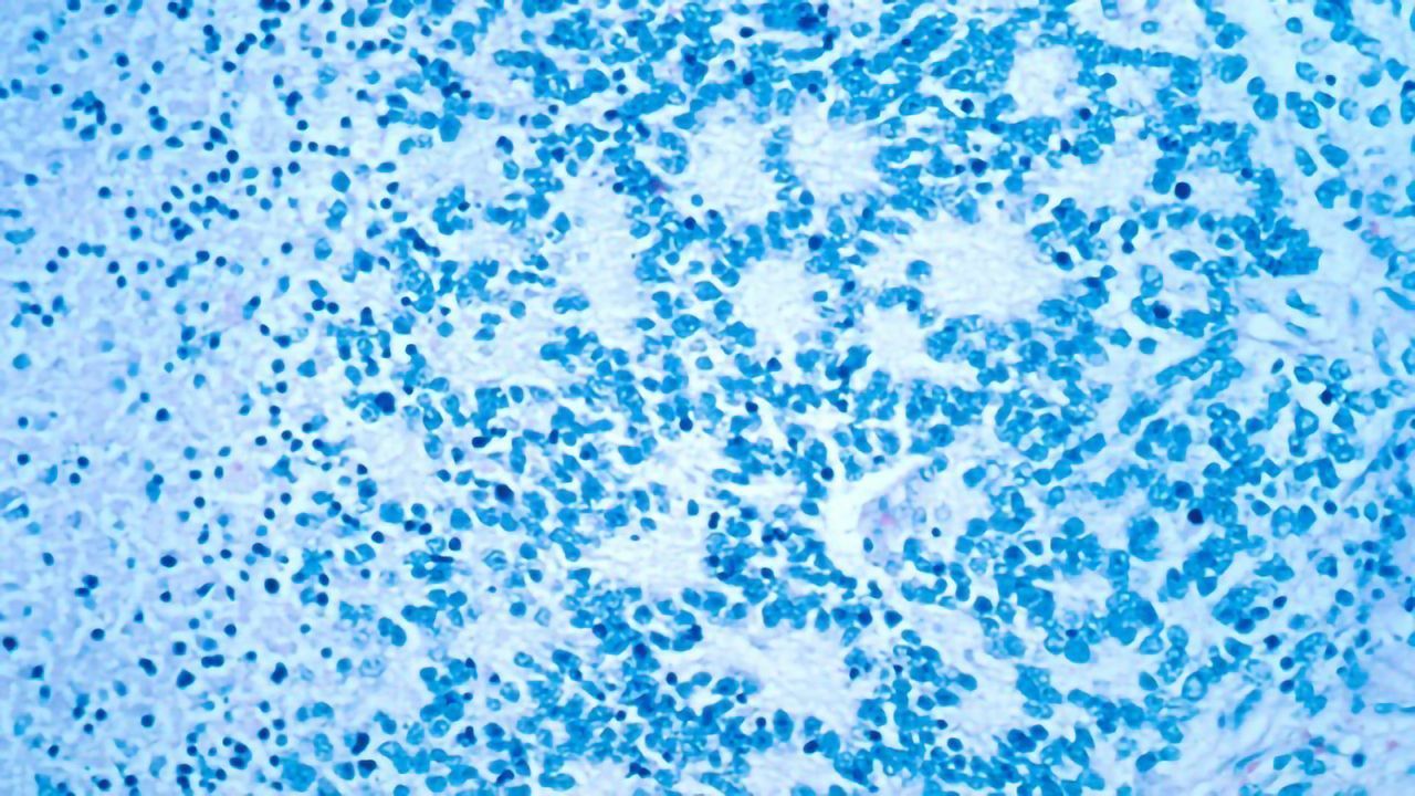 Team Identifies Genetic Marker Associated With Aggressive Childhood Cancer