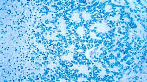 Team Identifies Genetic Marker Associated With Aggressive Childhood Cancer
