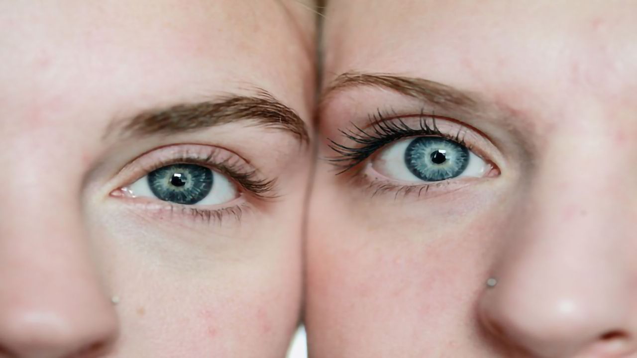 Twin Study Reveals Common Genetic Risk Factors for PTSD and Migraine