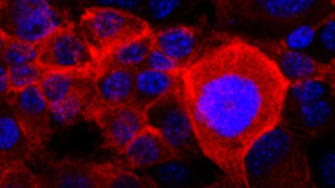 Mechanism May Explain How Pancreatic Cancer Cells Dodge Treatments