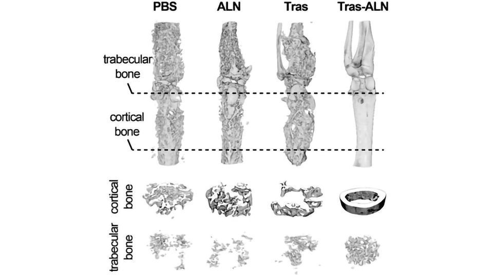 Antibody Conjugate Delivers Drug to Bone Tumors and Inhibits Metastasis content piece image