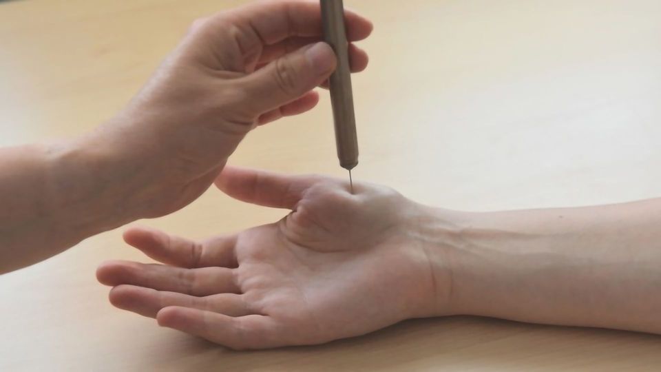 Why Nerve Injuries Could Lead to Hypersensitization  content piece image