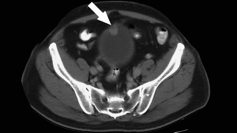 Novel Approach Yields Potential Drug Candidate for Bladder Cancer  content piece image