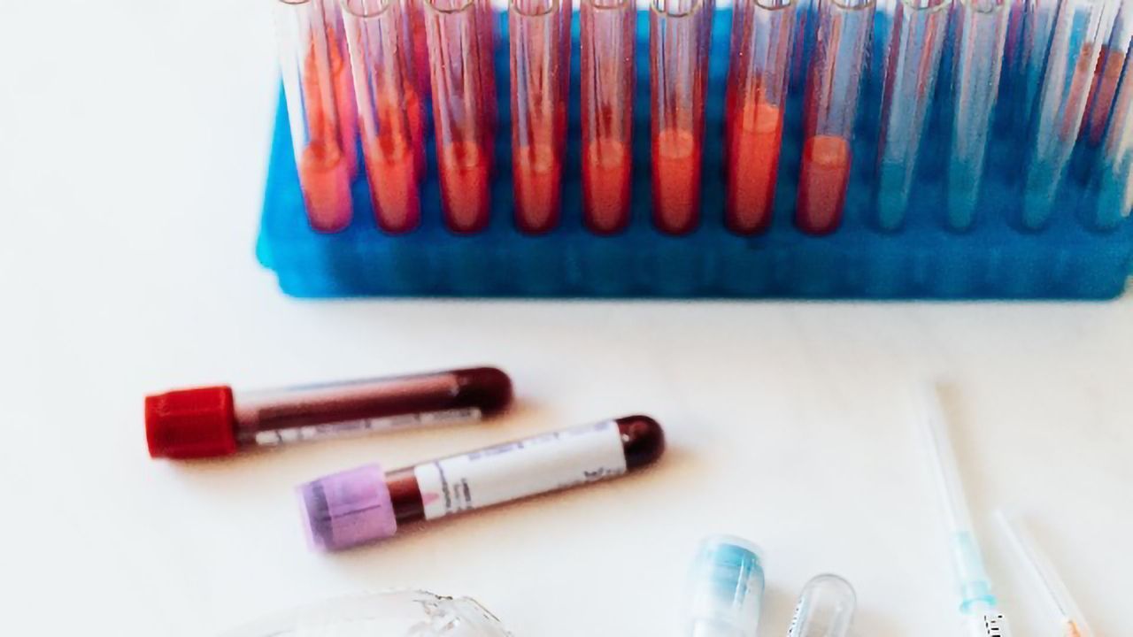 Simple Blood Test for Early Detection of Alzheimer's Disease Developed