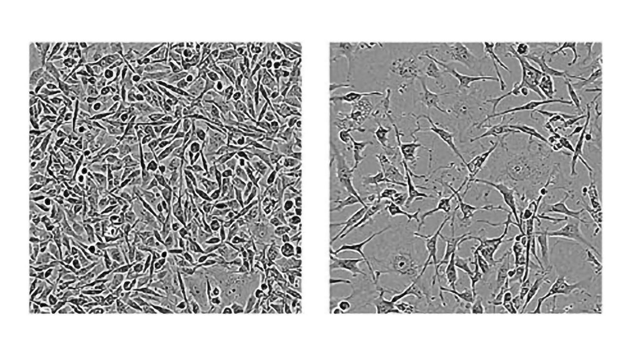 RNA-Binding Proteins May Provide a New Approach to Treating Breast Cancer