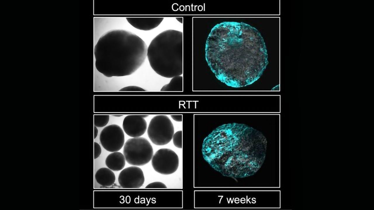 Genetic Mechanism Behind Rett Syndrome Identified