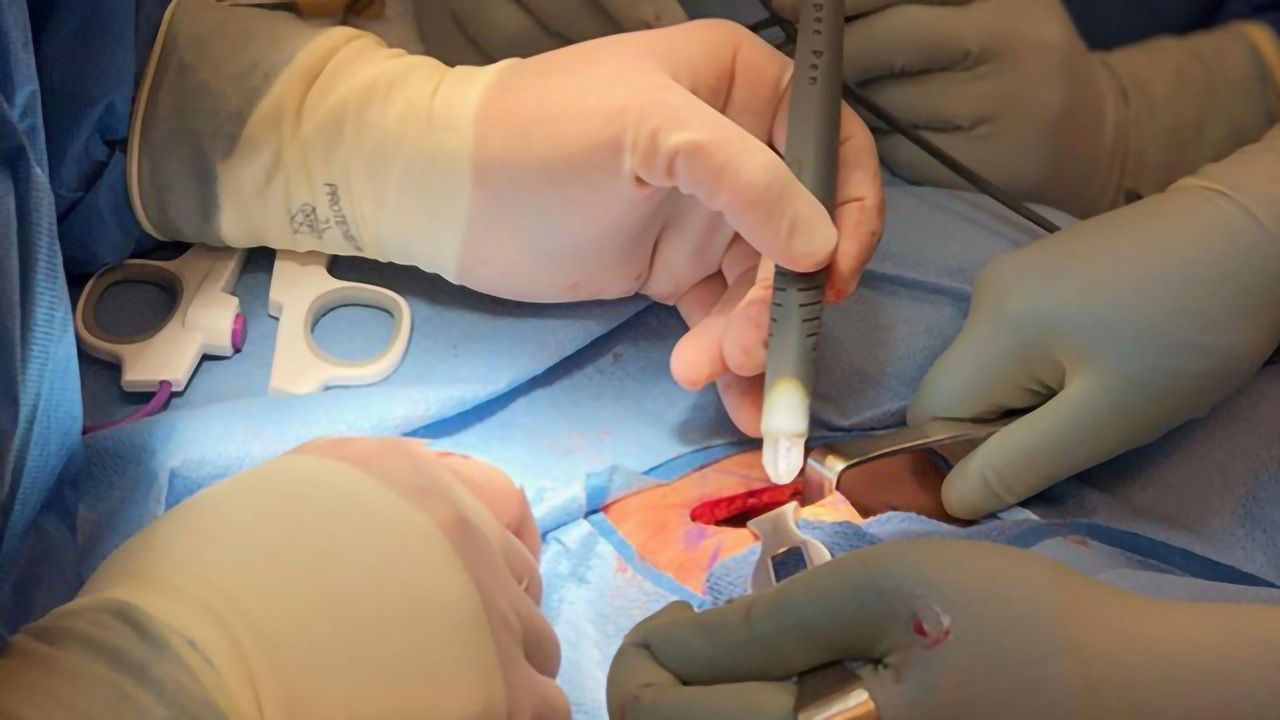 MasSpec Pen Tested in Pancreatic Cancer Patients During Surgery