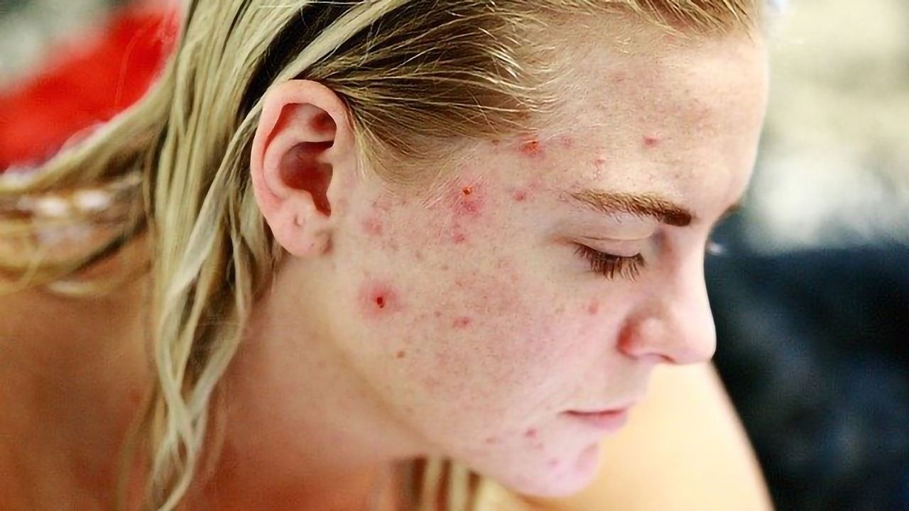 Getting Under Your Skin: The Immunology of Cuts and Bruises