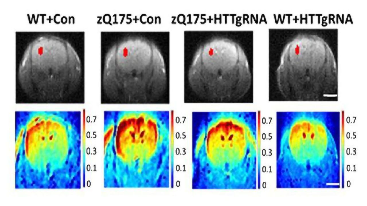 Slowing Down Huntington’s Disease With Gene Therapy