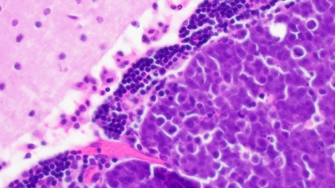 Medulloblastoma in the Mouse Cerebellum