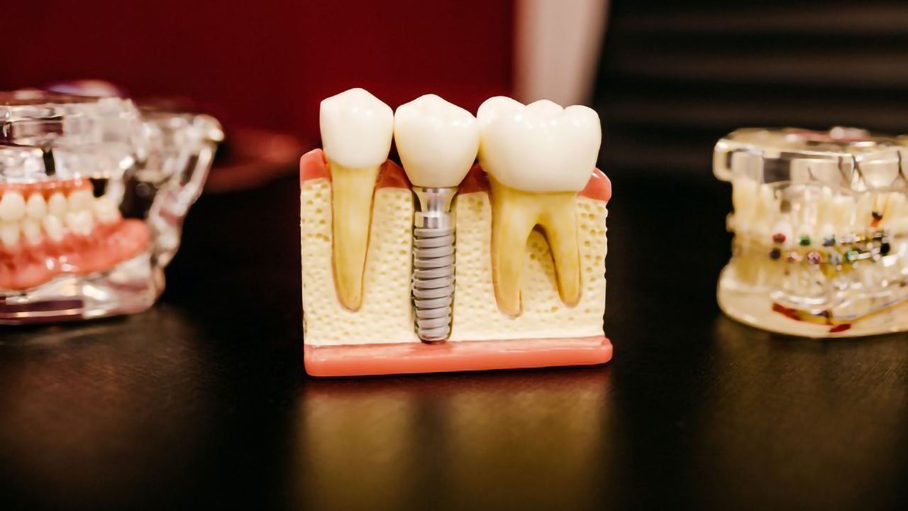 Tooth Loss Linked to Dementia Risk