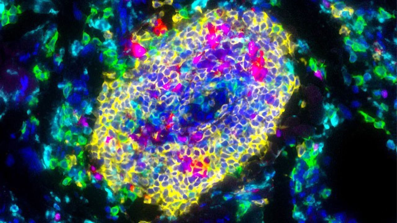 Tertiary Lymphoid Structures in Sarcoma