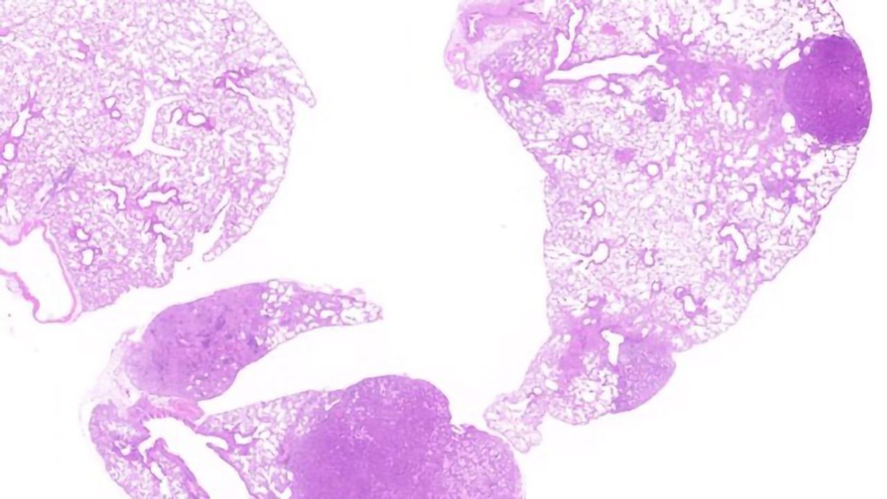 Impact of KRAS Isoforms in Human Cancers