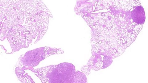 Impact of KRAS Isoforms in Human Cancers